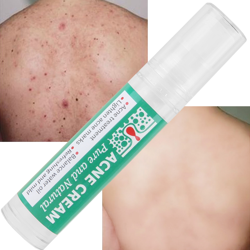 Natural Oil Control Shrink Pores Cleaning Skin Care Whitening Acne Treatment Cream