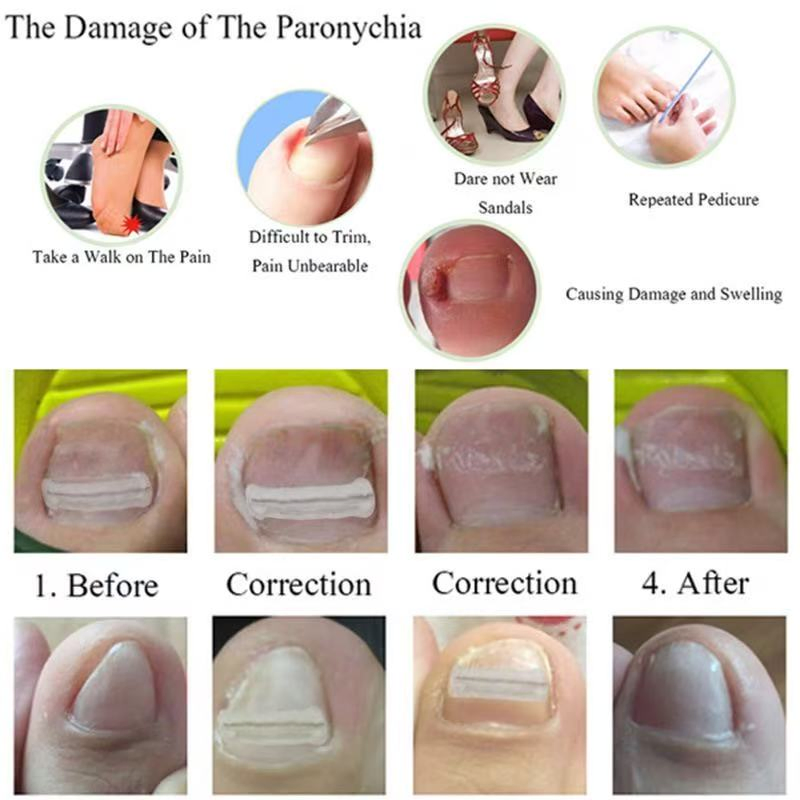 Titanium Alloy Material Ingrown Toenail Corrector for Curved or Ingrown Nails