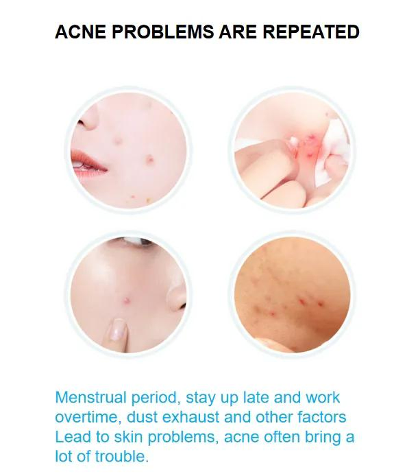 Wholesale Factory Price Private Label OEM Hydrocolloid Acne Patch, Pimple Patch and Spot Patch for Blemish and Zit