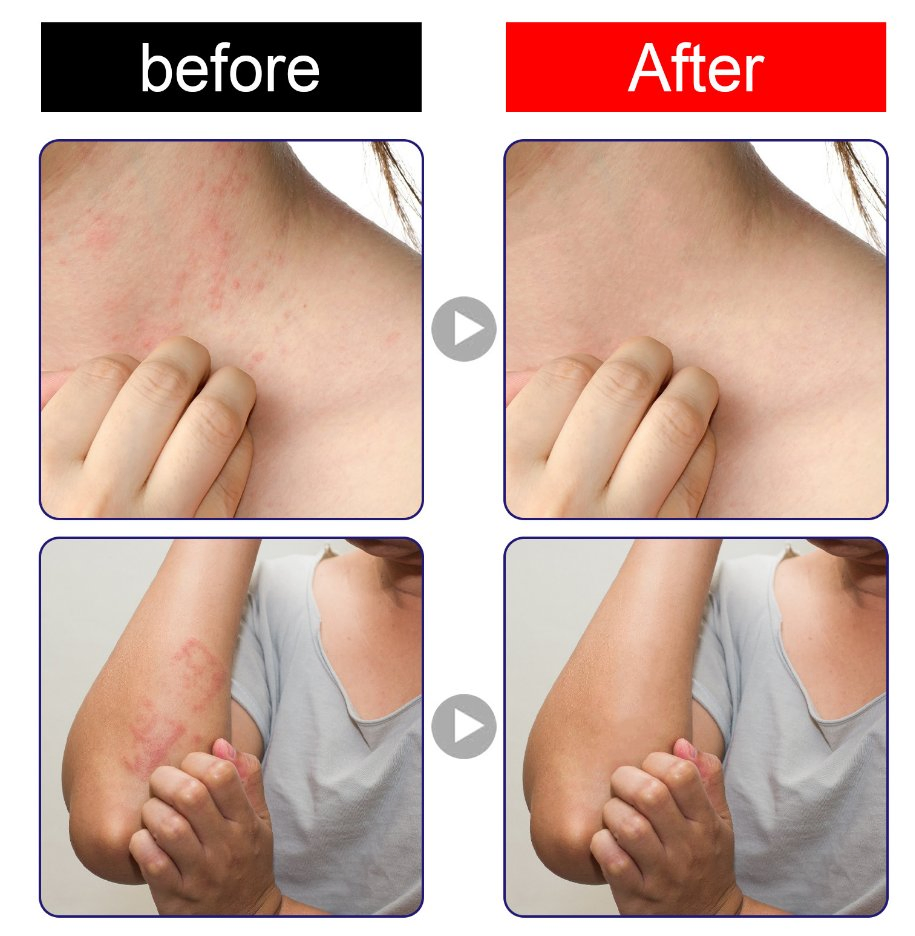 Online Wholesale in Stock Herbal Anti Bacterial Cream Mild Anti-Itch Relief From Mosquito Bites Antipruritic Herbal Cream
