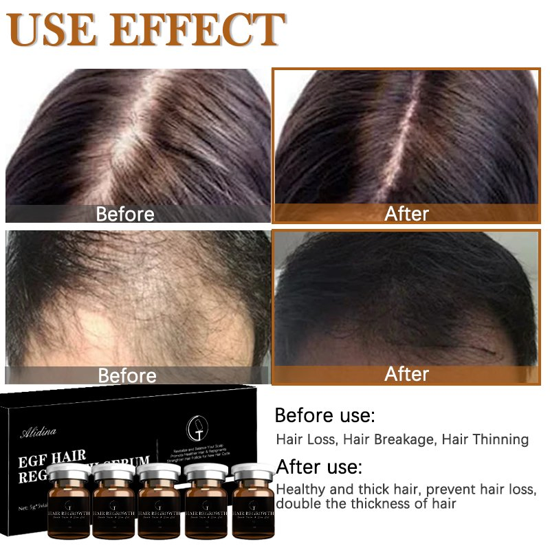 Peptide Hair Density Serum Deep Nourishment for Anti-Hair Loss Scalp Care Natural Hair Regrowth Micro-Infusion Serum
