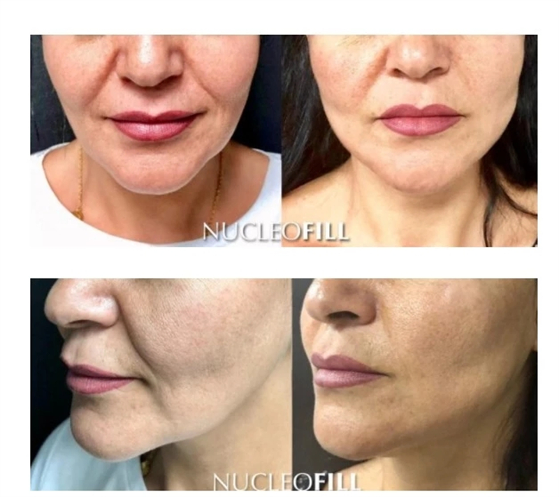 Korean Nucleofill Dermal Filler: Face Lifting & Medium Skinbooster (by Promoitalia)