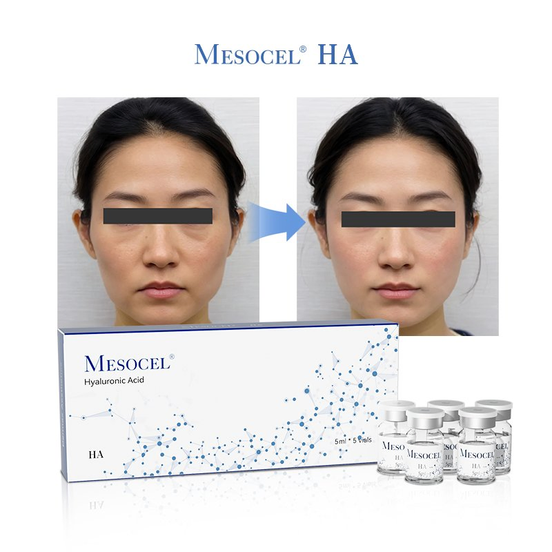 Higher Concentration Skin Care Product for Mesotherapy Solution with Hyaluronic Acids