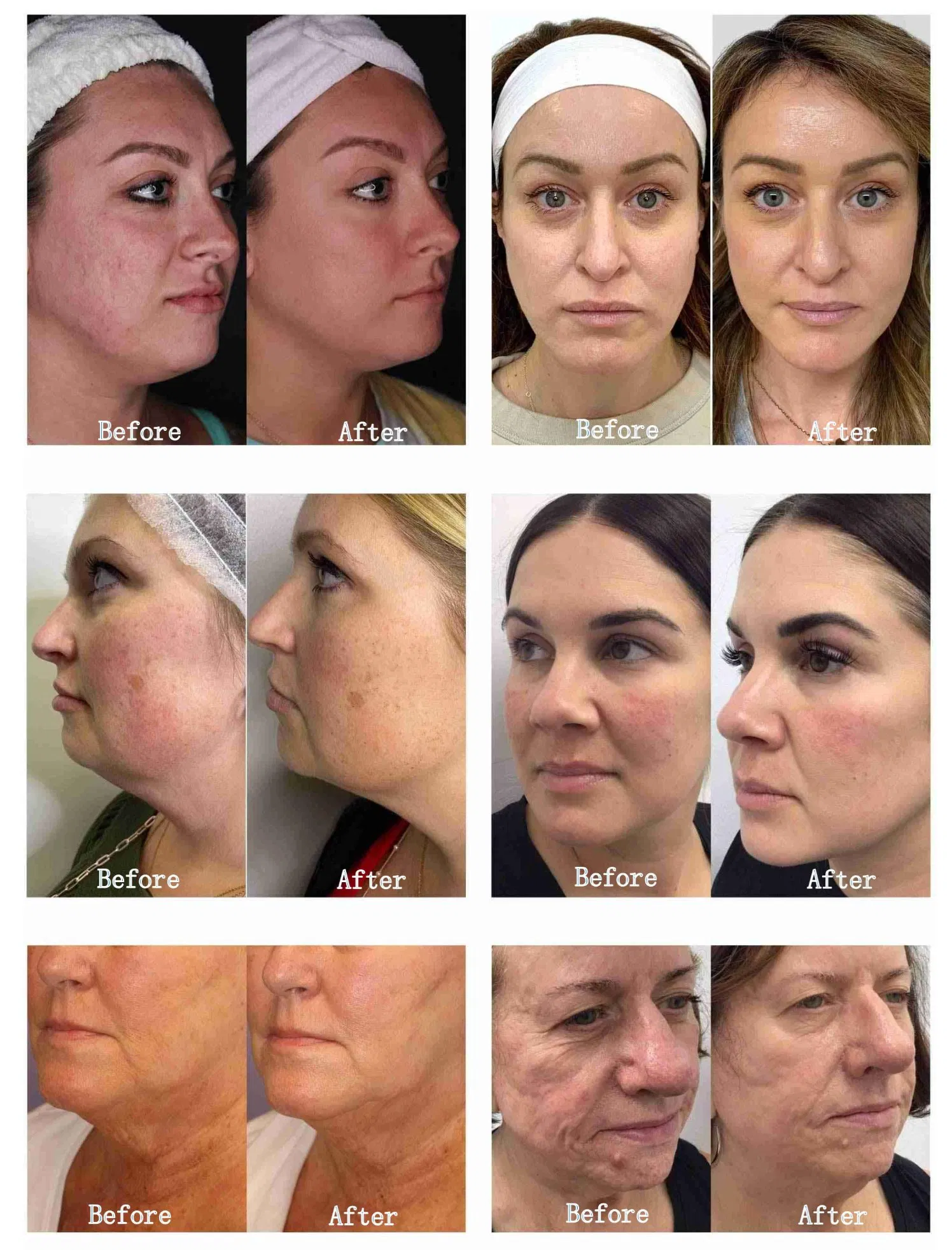 Дермапен Derma Pen для ухода за кожей