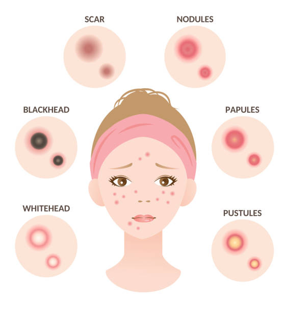 China Manufacture Hydrocolloid Acne Pimple Patch Crystal Flower Shaped Acne Patch