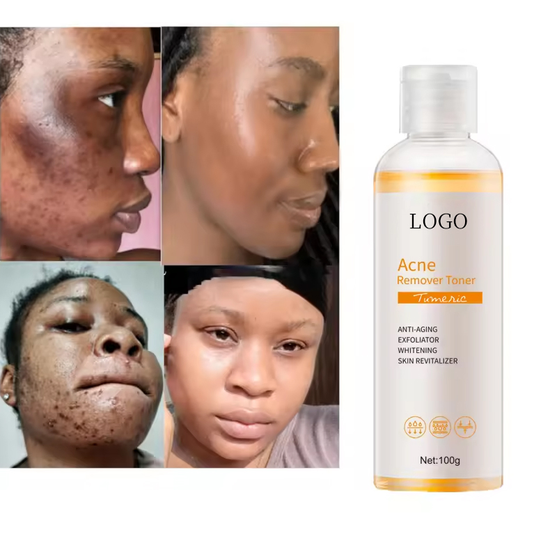 Ditong OEM/ODM Acne Removing Toner