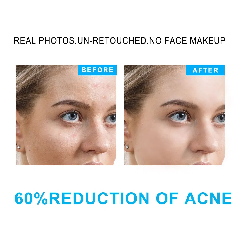 Custom Logo Vegan Natural Salicylic Acid Acne Skin Care Set Pores Minimizing Blemishes Acne Prone Skincare Essentials Set Kits