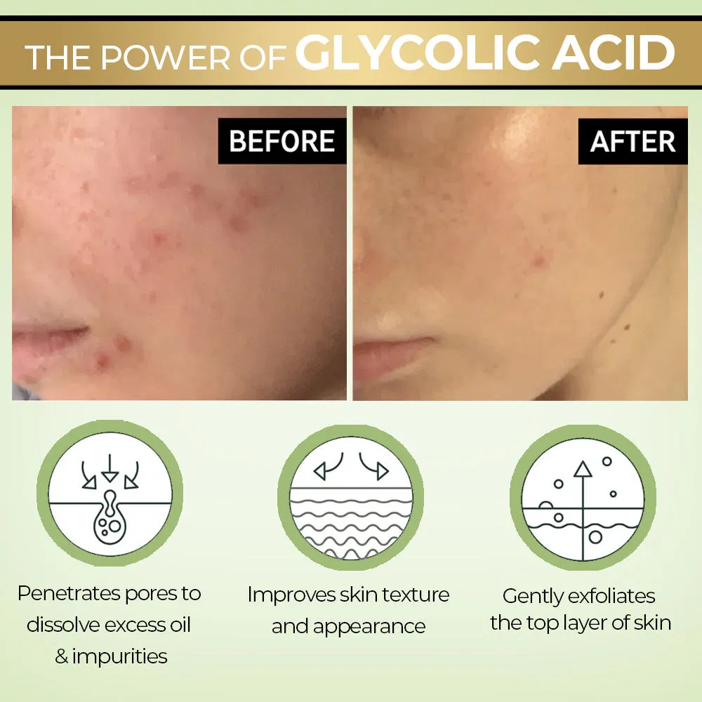 10% Glycolic Acid Hyaluronic Acid Acne Treatment Hydrating Brightening Face Toner