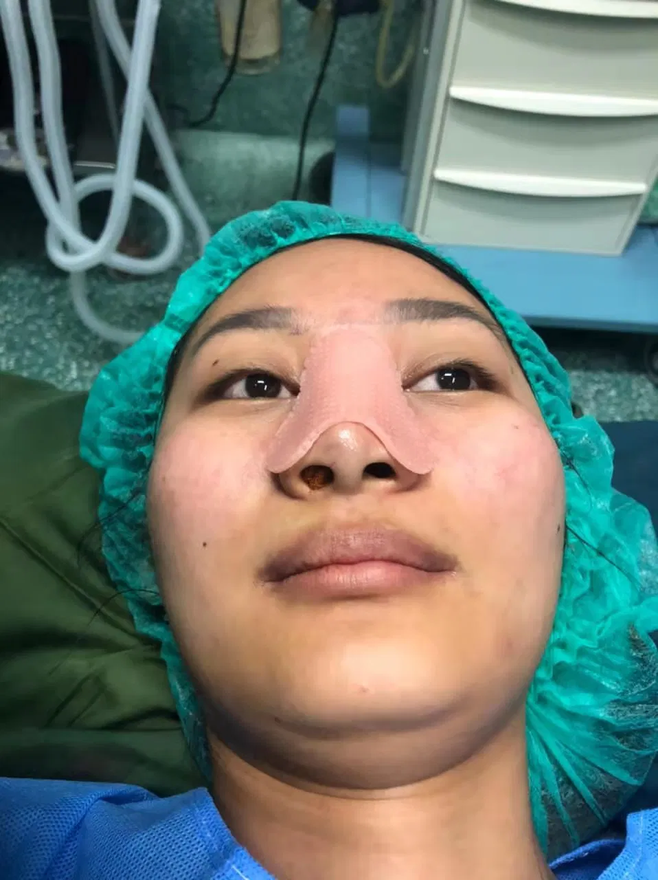 External Thermoplastic Nasal Splint Fracture Nose Plaster