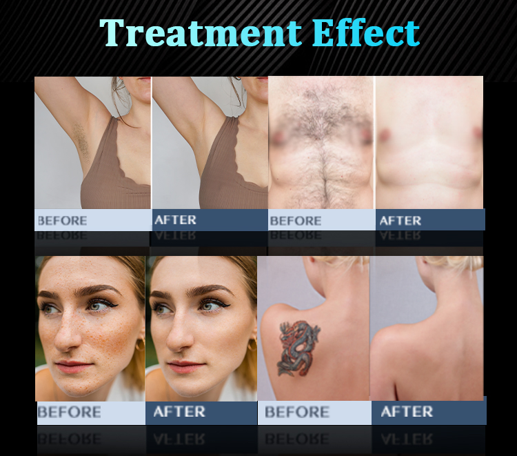 High Power Laser Diode Module and Pico Laser 2 in 1 Hair Removal Skin Rejuvenation Machine