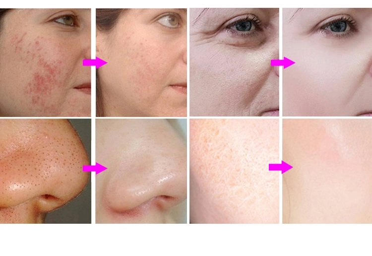 Гидродермабразионный аппарат Hydra Beauty 7 в 1