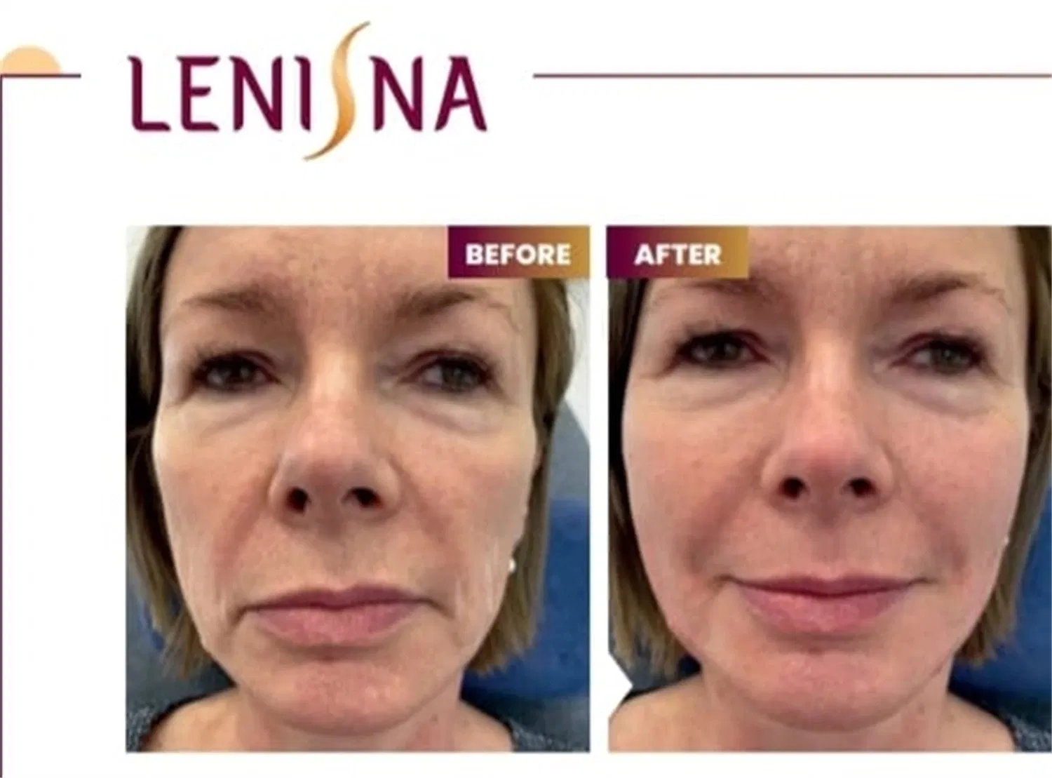 New Product Korea Lenisna Collagen Injection PLA+Ha Hybrid Filler 200mg/Vial