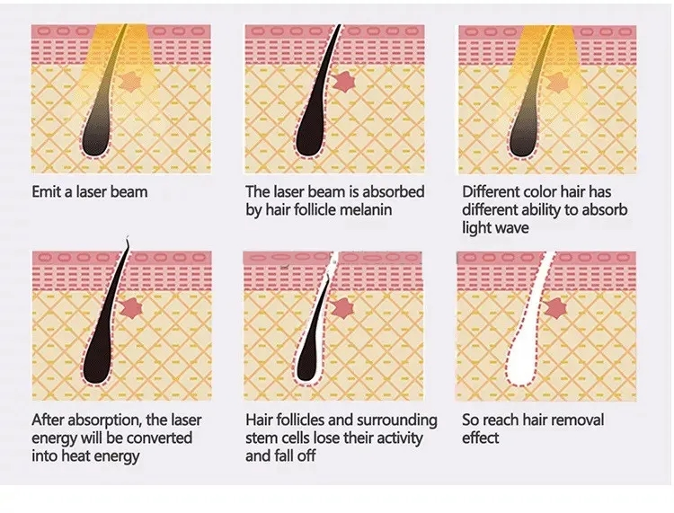 Q Switch ND YAG Laser Diode Machine Body and Neck Throat Hair Removal Skin Rejuvenation Firming Moisturizer Pore Cleaner