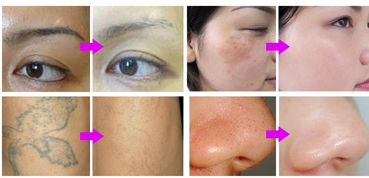 ND YAG Laser Beauty Salon Equipment Qswitch Laser Tattoo Removal
