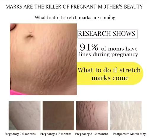 300g Stretch Marks Rose Massage Cream Body Lotion
