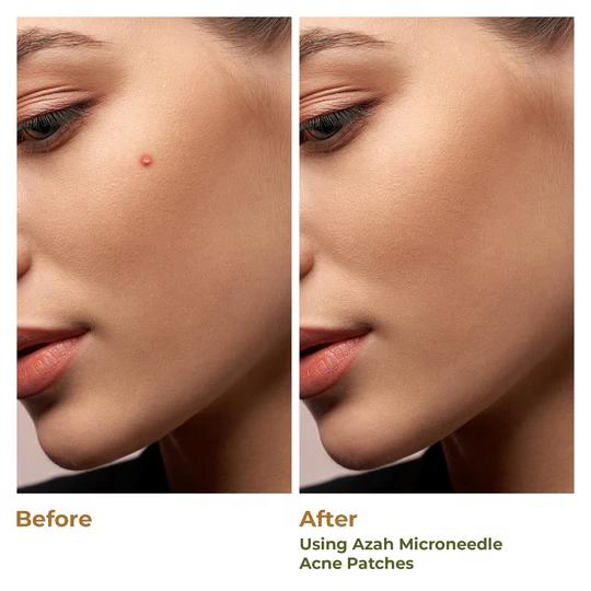 Custom Vegan Hydrocolloid Micro-Needle Acne Patch Pimple Treatment Patch for Face Acne