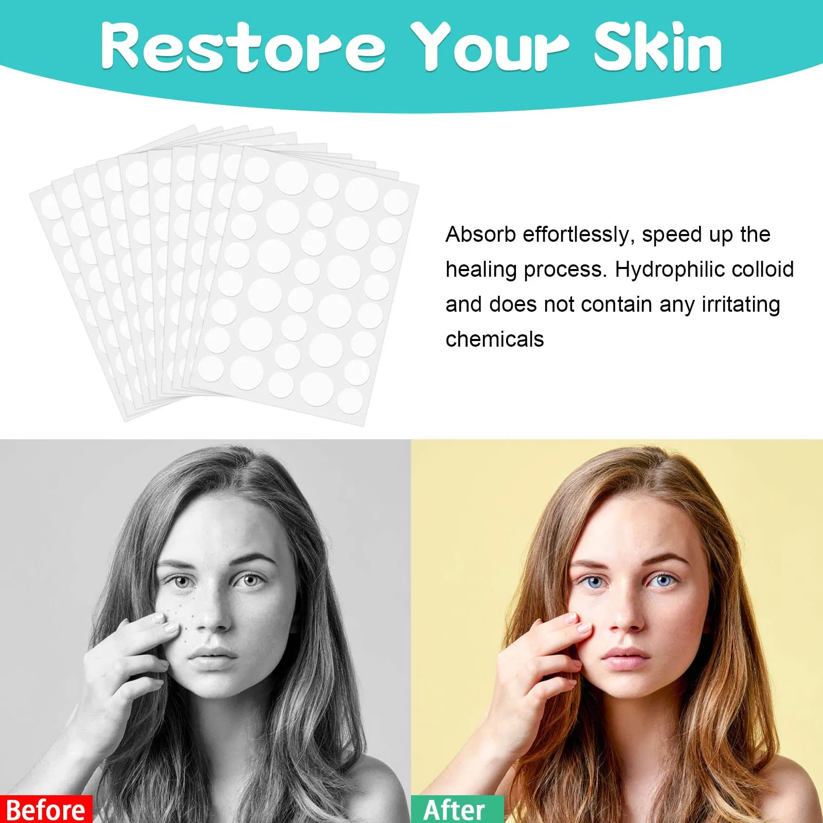 36 пластырей от прыщей с салициловой кислотой