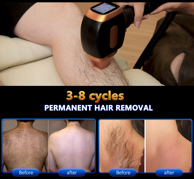 2025 Newest 755nm 808nm 1064nm 940nm Professional Ice Painless Diode Laser Hair Removal Machine