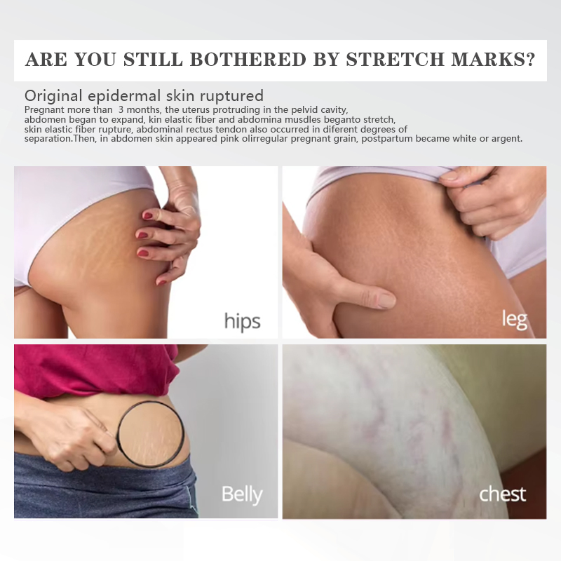 OEM Body Face Oil Natural Organic Scars Stretchmarks Skincare Hydrates Skin Anti Stretch Marks Scar Stretch Marks Repair Kit