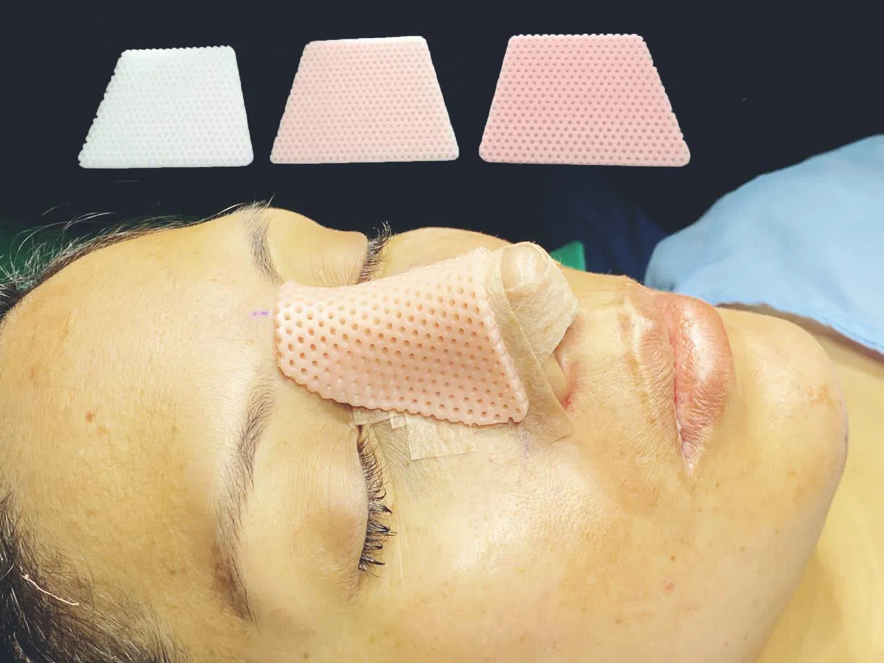 Factory Direct Source Thermoplastic Nasal Splint