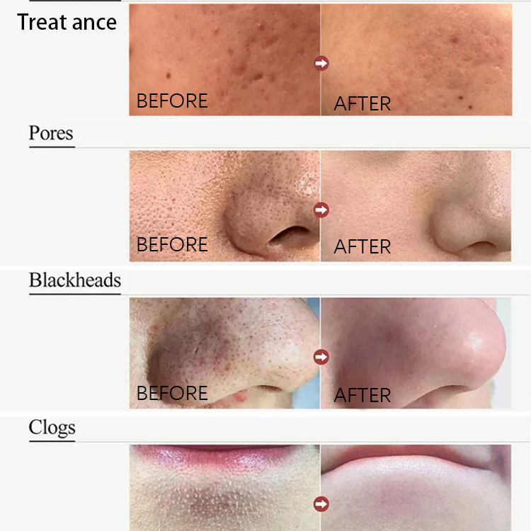 Natural Acne Treatment Face Cleans Wash Remove Blackheads & Ance Anti Acne Treatment Salicylic Acid Face Wash