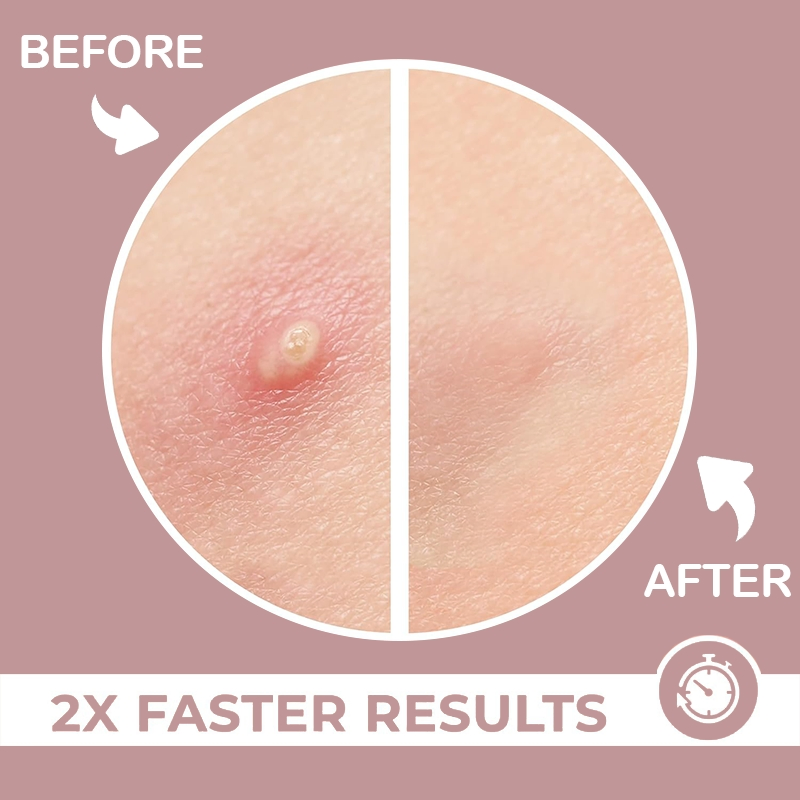 Zs Fast-Acting Zit Patches for Pimples & Blemishes Hyaluronic Acid Microdart Pimple Patches Clear Pores Calm Irritation Nano Microneedling Patch