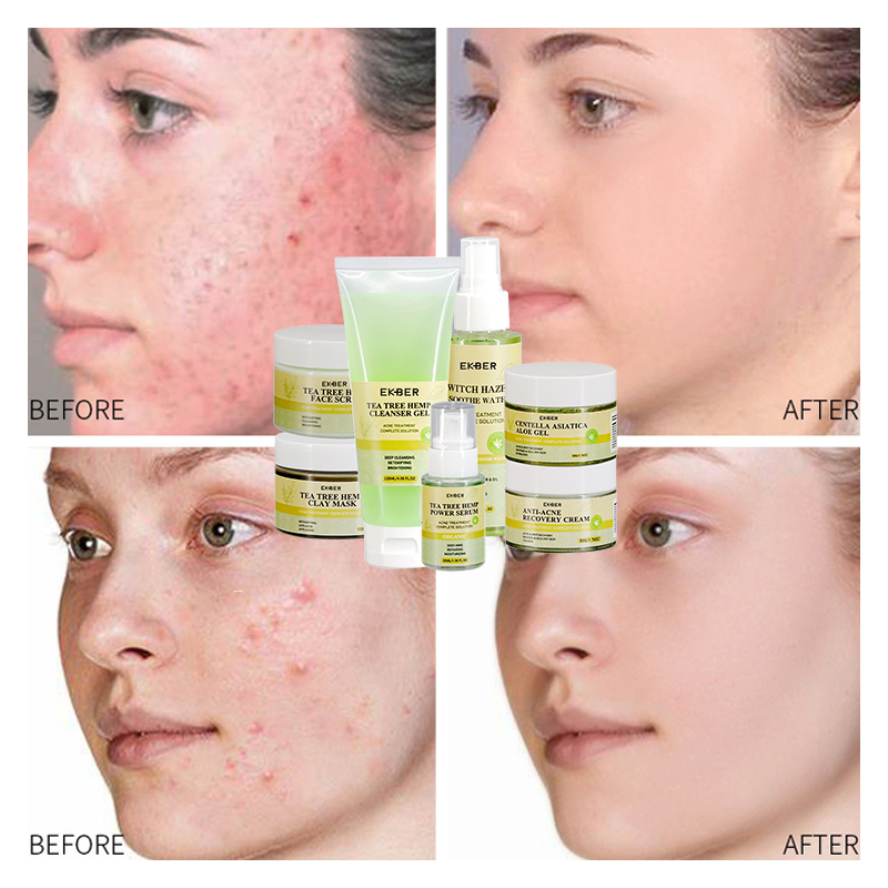Private Label Tea Tree Face Care Set Skin Care Whitening Anti Acne Treatment Skin Beauty Skin Care Set