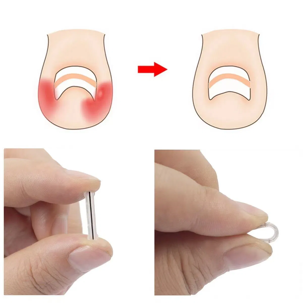 10PCS Ingrown Toenail Corrector Strips for Curved Toenail Quick Relief, 4 Multi-Sizes Ingrown Toenail Treatment Relief Tools Kit for Home Use