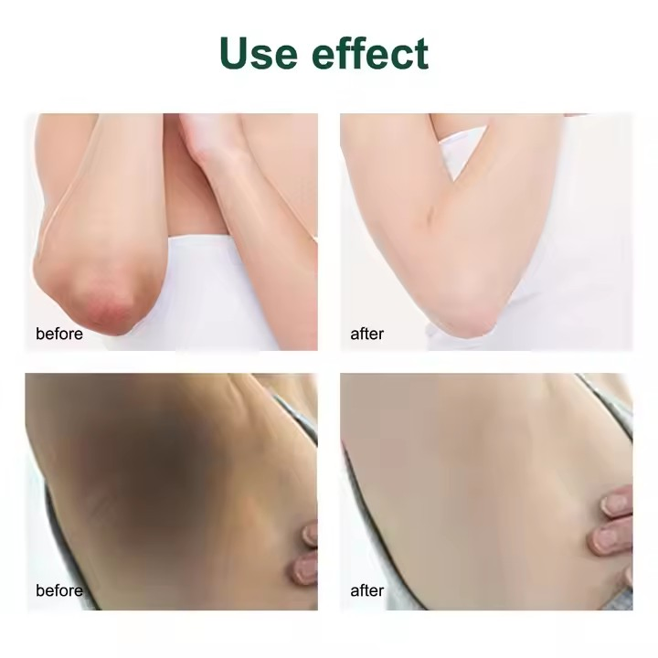 Factory Price Highly Effective OEM Natural Vegan Neck Facial Vitamin C Acne Pimples Dark Spot Strong Freckle Remover Cream