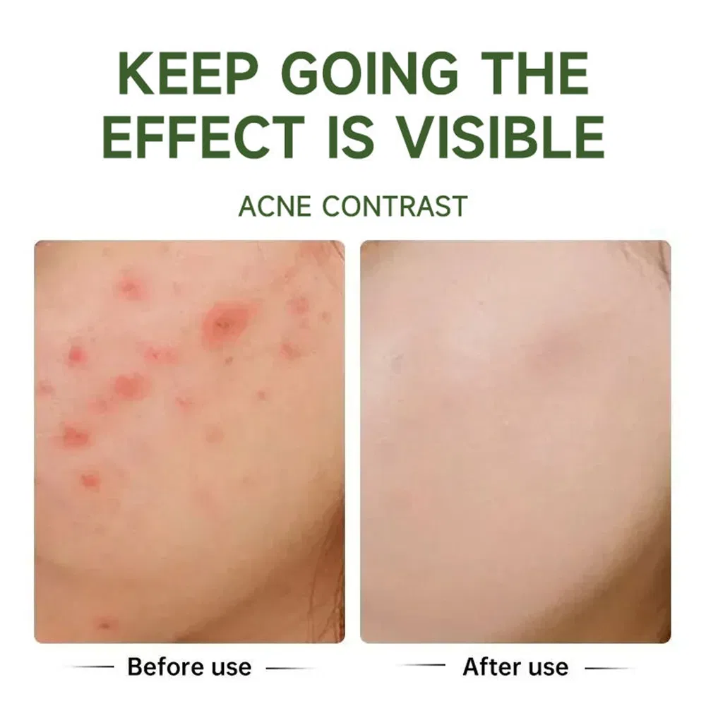 Gently Improves Smooth Refreshing Facial Soothing Moisturizing Anti-Acne Salicylic Acid Face Cream