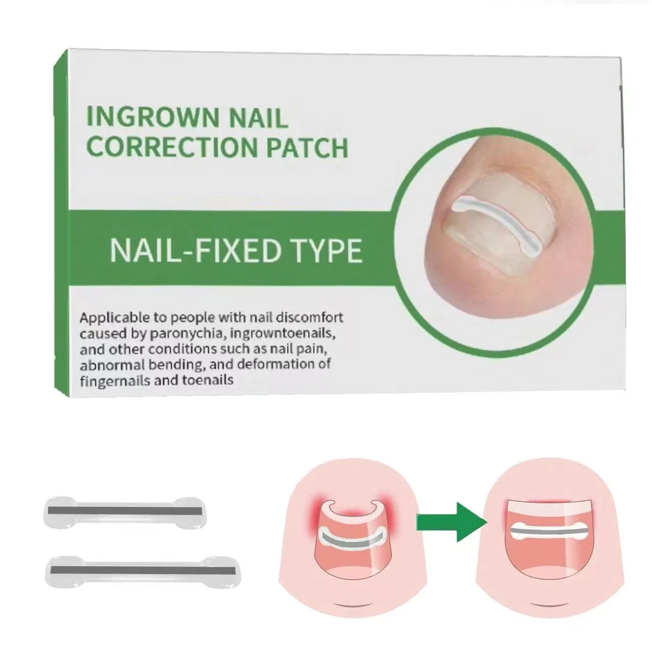 Professional Home Care for Curved Nails Titanium Alloy Ingrown Toenail Treatment