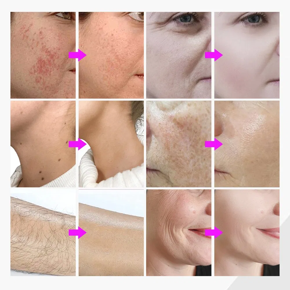 Permanent 5in1 Non-Laser Electrolysis Epilation Device Blend Electrolysis Hair Removal Needle Machine Face and Body Clinic Use