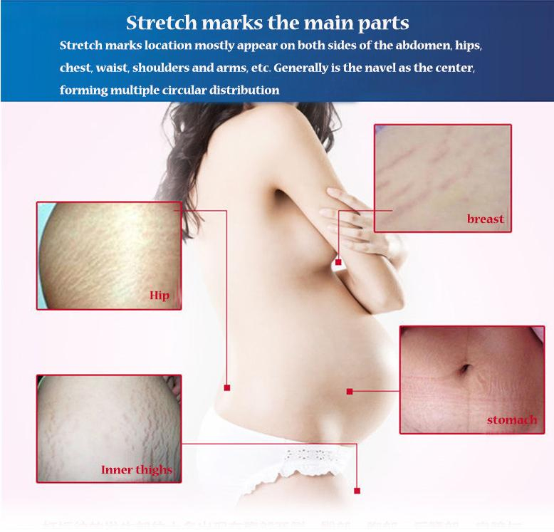 OEM Anti-Wrinkle Stretch Mark Cream Postpartum Repair Scar Slack Line for Woman