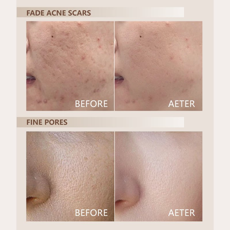 Spongilla Spicules Hydrolyzed Sponge Extract Powder Bio Microneedling Anti-Aging Acne Treatment Natural Algae Peeling Therapy