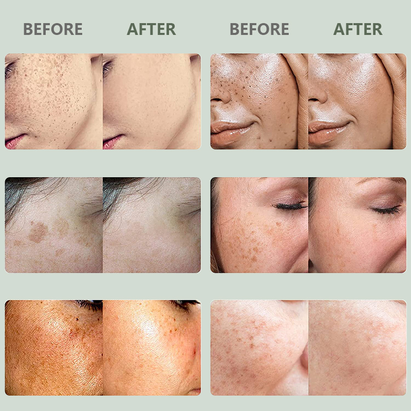 Private Label Salicylic Acid Acne Treatment Skincare Whitening Salicylic Acid Skin Care Set Wholesale