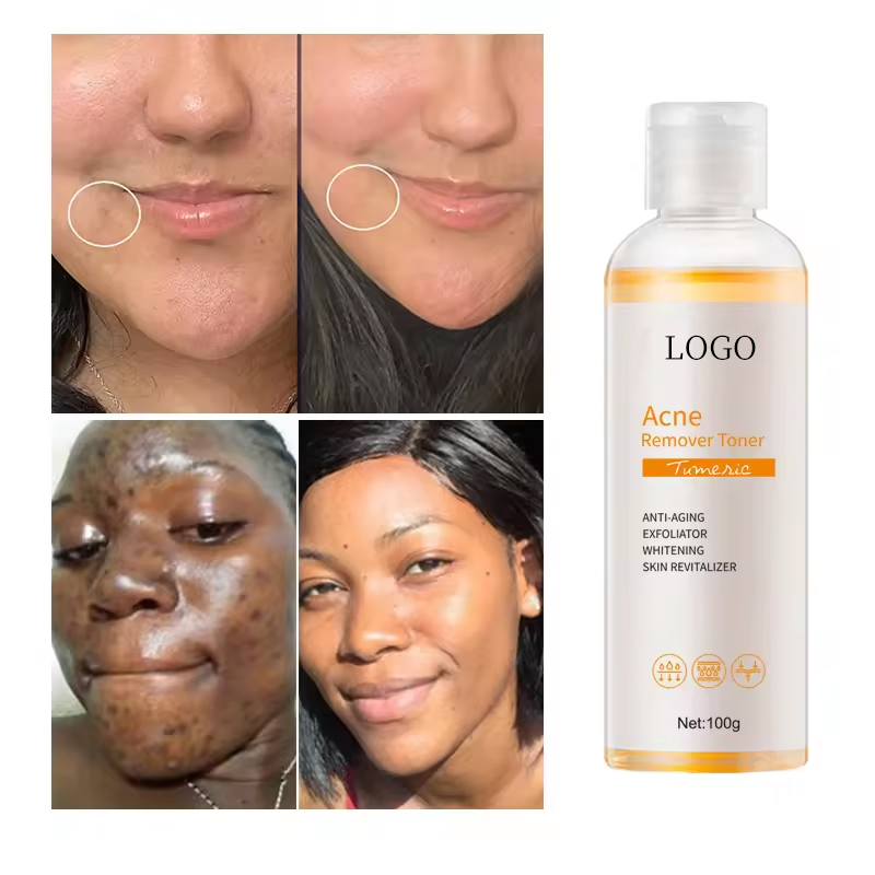 Ditong OEM/ODM Acne Removing Toner