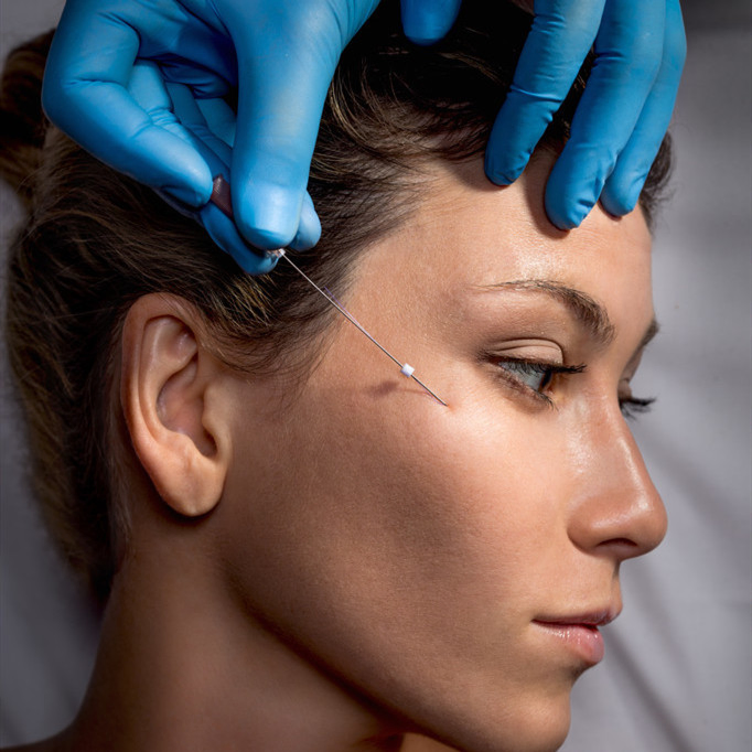 Factory Sale Thread Lift Face /Pdo Thread Lift /Plla Lifting Thread