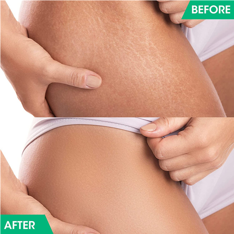 Private Label Natural Moisturizer Cream Advanced Stretch Mark Removal Cream
