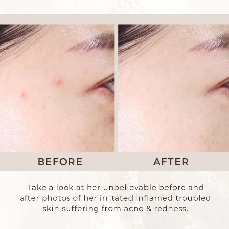 Acne Repair Gel Moisturizing 50ml Face Wash Gel for Face to Control Oil and Clear Breakouts