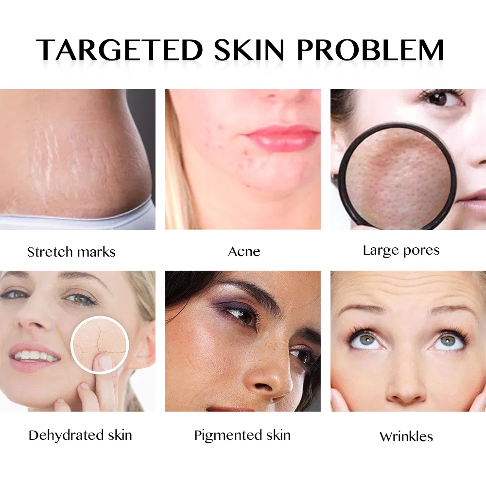 Micro Derma Rollong System 540 Titanium Needles Mts Derma Roller