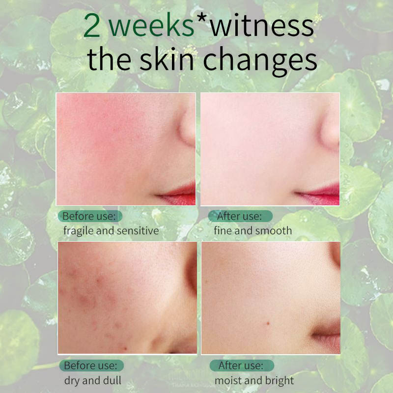 Centella Titrated Extract Oinment Face Cream Auxiliary Healing Soothes Problem Skin
