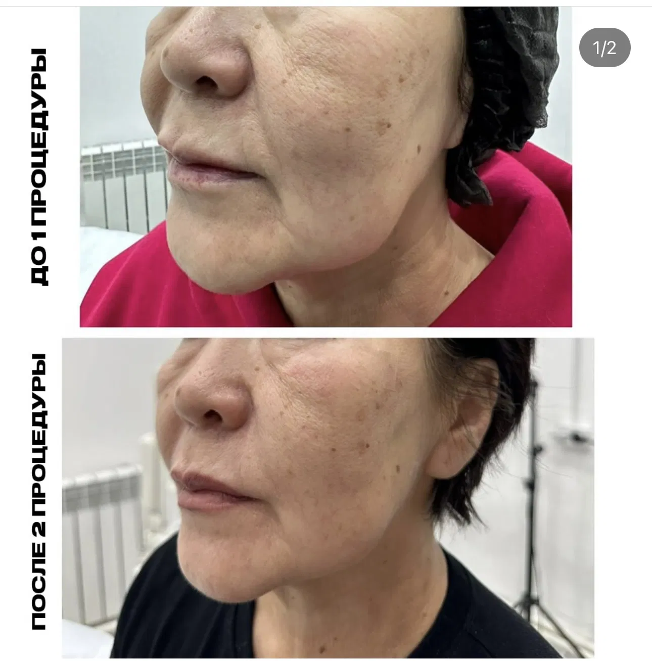 Korea Original Gouri Pcl Power Booster Skin Boosters 2ml Anti Aging Hydration Elasticity Lifting and Whitening Skin Dermal Fillers