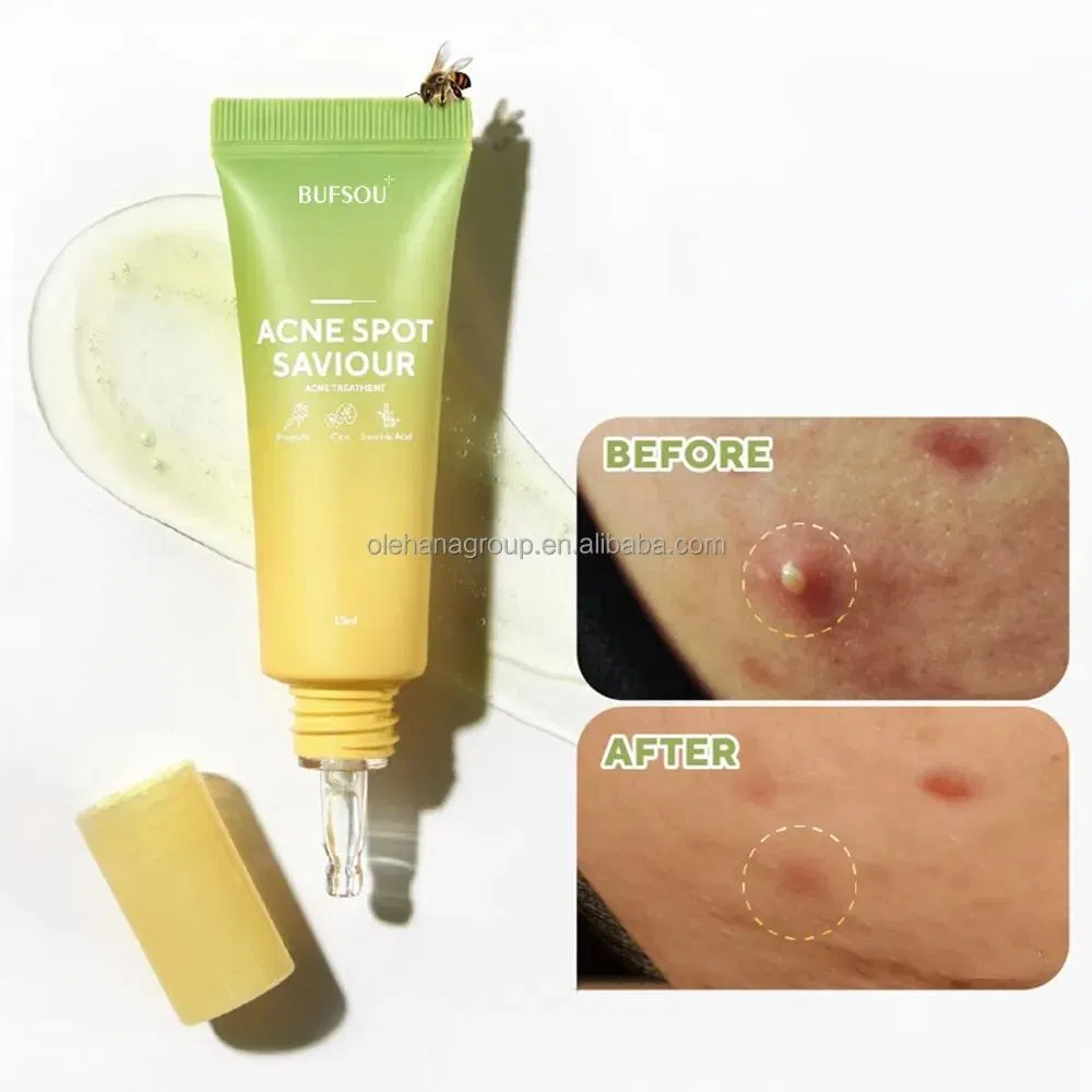 Blackheads Blemishies Pimple Removal Face Skin Care Whitening Facial Moisture Repair Gel Cream Acne Treatment Acne Spot Cream