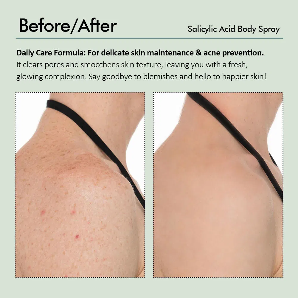 Salicylic Acid Body Spray Oil Control Moisturizing Pore Shrinking Blackhead Remover