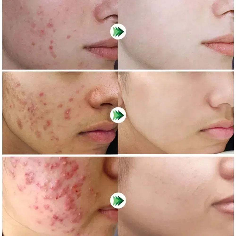 Gently Improves Smooth Refreshing Facial Soothing Moisturizing Anti-Acne Salicylic Acid Face Cream