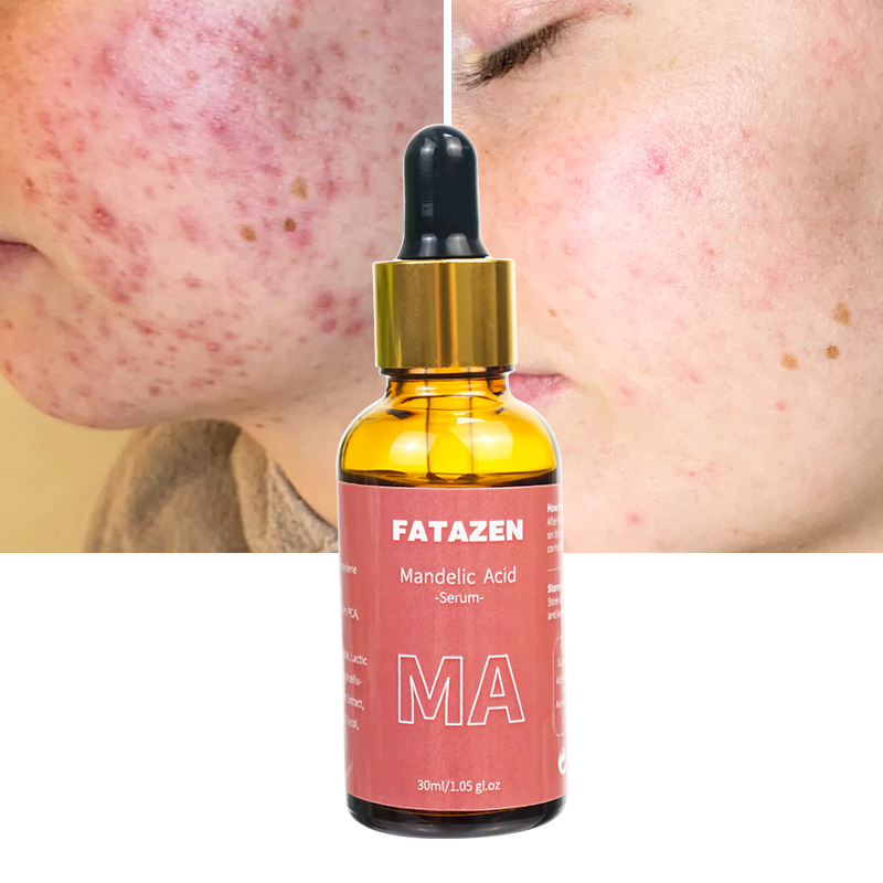 Reduce Acne Marks Repairing Shrink Pores Faded Spot Mandelic Acid Facial Serum