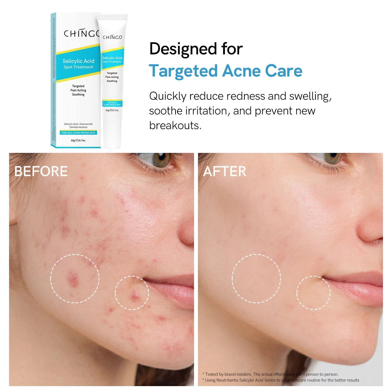 Salicylic Acid Spot Treatment Cream No Irritation Soothing Ance Removal Cream
