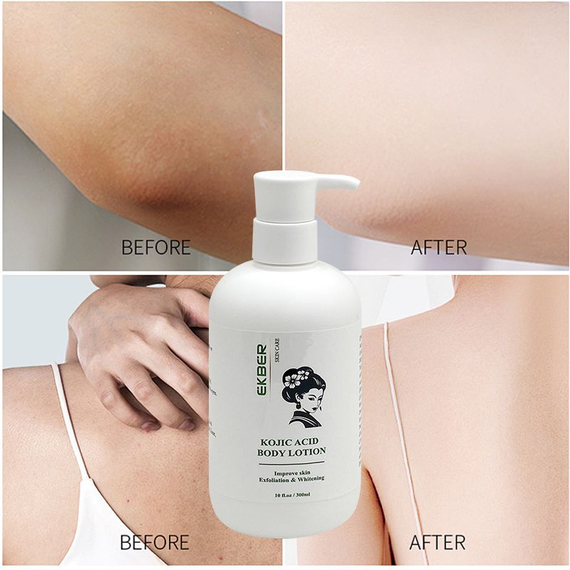 Kojic Acid Body Lotion Soap Anti-Acne Kin Care Set for Women
