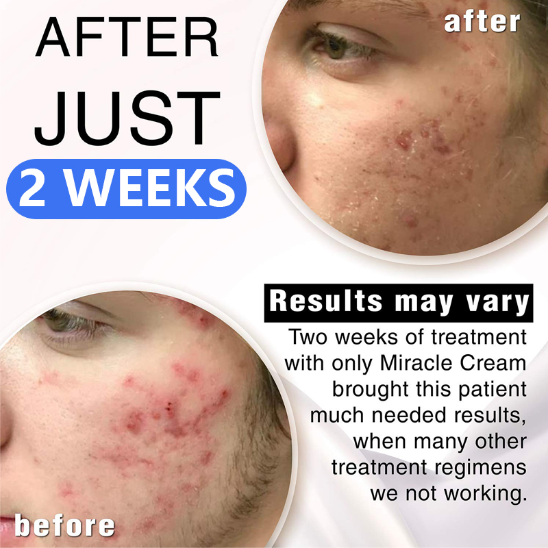 Face Cream for Dry Skin Callus Remover Cream Moisturizing Vitamin E Urea 40% Cream