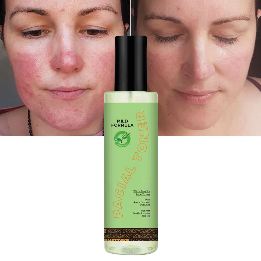 Sensitive Skin Care Products Redness Relief Anti-Allergy Moisturizing Facial Toner